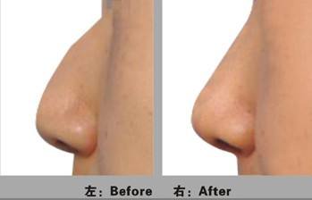 <a href=http://www.f3bb6.cn/listinfo-756-0.html target=_blank class=infotextkey>駝峰鼻矯正</a>手術步驟及術后注意事項