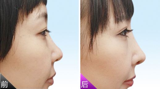 膨體<a href=http://www.f3bb6.cn/listinfo-737-0.html target=_blank class=infotextkey>隆鼻</a>術后的注意事項