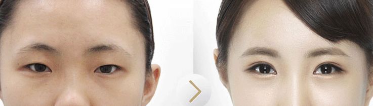 韓式長期<a href=http://www.f3bb6.cn/listinfo-724-0.html target=_blank class=infotextkey>雙眼皮</a>價格