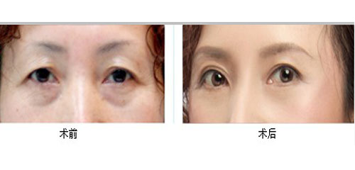 治療眼瞼下垂多少錢