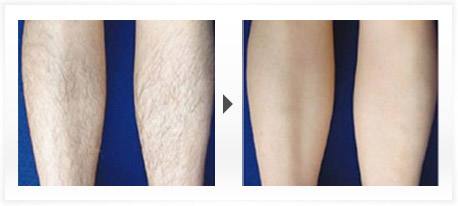 何為光子<a href=http://www.f3bb6.cn/listinfo-670-0.html target=_blank class=infotextkey>脫毛</a>技術