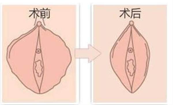 大陰唇整容如何糾正