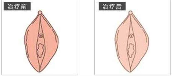 矯正手術大陰唇危險嗎
