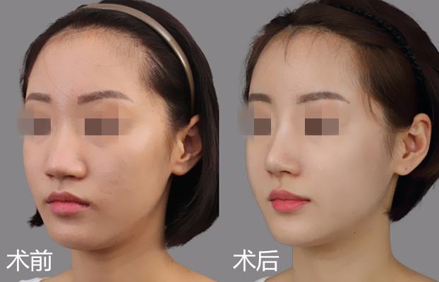 杭州天津做自體軟骨<a href=http://www.f3bb6.cn/listinfo-737-0.html target=_blank class=infotextkey>隆鼻</a>要多少錢