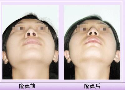 膨體<a href=http://www.f3bb6.cn/listinfo-737-0.html target=_blank class=infotextkey>隆鼻</a>整形術多少錢