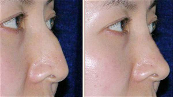 <a href=http://www.f3bb6.cn/listinfo-756-0.html target=_blank class=infotextkey>駝峰鼻矯正</a>是大手術嗎