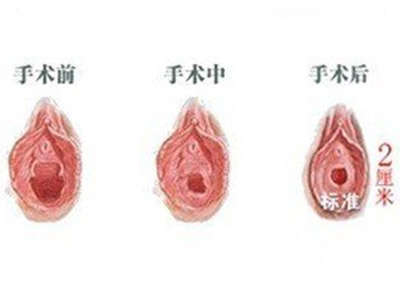 小陰唇手術(shù)愈合圖片