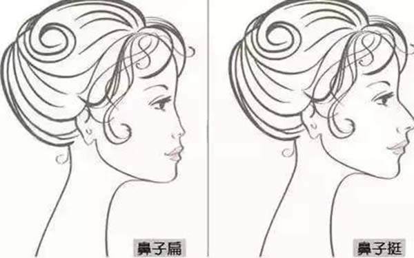 駱駝鼻手術方法