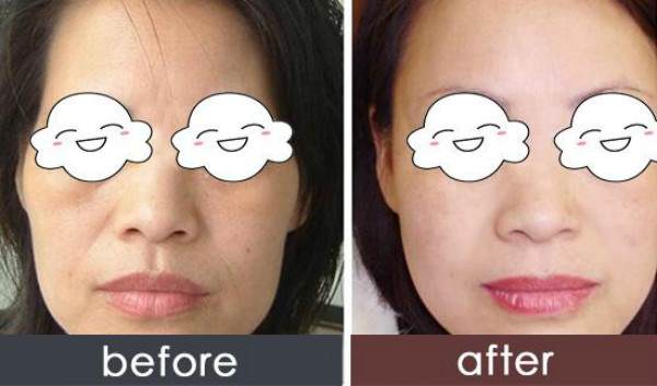 脂肪填充的注意事項