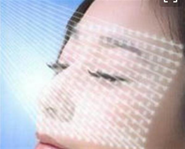 如何有效快速的去除紅血絲