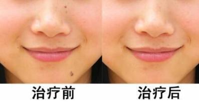 各種<a href=http://www.f3bb6.cn/listinfo-767-0.html target=_blank class=infotextkey>祛痣</a>方法的利弊