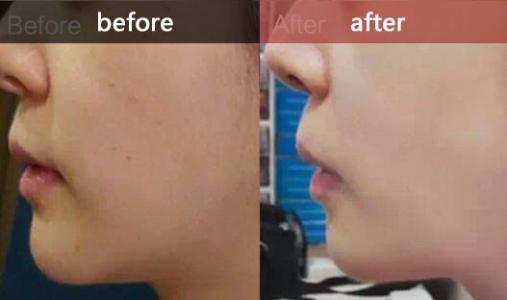 水光<a href=http://www.f3bb6.cn/listinfo-770-0.html target=_blank class=infotextkey>嫩膚</a>多久打一次