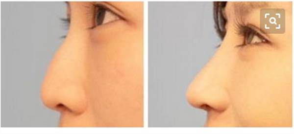 注射<a href=http://www.f3bb6.cn/listinfo-737-0.html target=_blank class=infotextkey>隆鼻</a>效果怎么樣呢