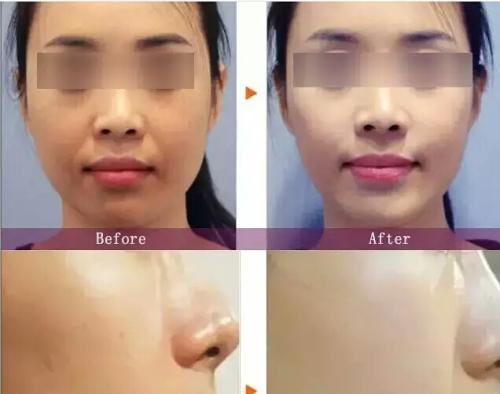 打完水光<a href=http://www.f3bb6.cn/listinfo-770-0.html target=_blank class=infotextkey>嫩膚</a>幾天有效