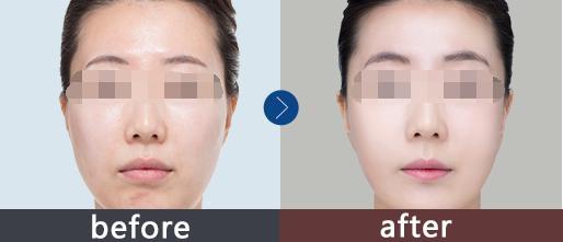 水光<a href=http://www.f3bb6.cn/listinfo-770-0.html target=_blank class=infotextkey>嫩膚</a>多少錢一針