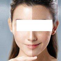 曬斑的預防和治療