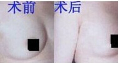 乳房肥大影響生活該怎么辦
