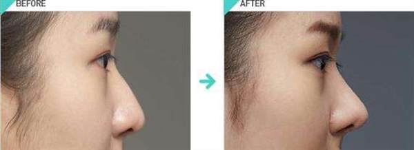 假體<a href=http://www.f3bb6.cn/listinfo-737-0.html target=_blank class=infotextkey>隆鼻</a>后會不會有后遺癥發生