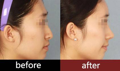 韓式<a href=http://www.f3bb6.cn/listinfo-737-0.html target=_blank class=infotextkey>隆鼻</a>整形會有后遺癥嗎