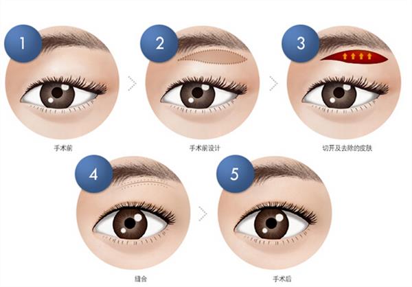 <a href=http://www.f3bb6.cn/listinfo-655-0.html target=_blank class=infotextkey>切眉</a>會留下疤痕嗎