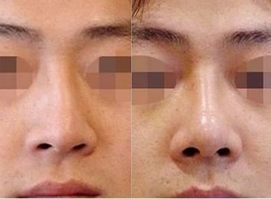 畸形鼻矯正價格