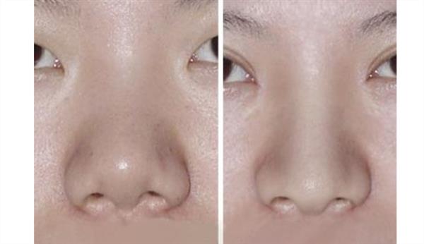 自體軟骨<a href=http://www.f3bb6.cn/listinfo-737-0.html target=_blank class=infotextkey>隆鼻</a>危害