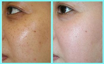 怎樣才能讓雀斑消失