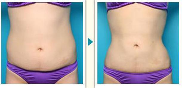 肚子上妊娠紋怎么消除