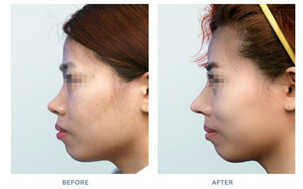 膨體和人工骨哪個好?