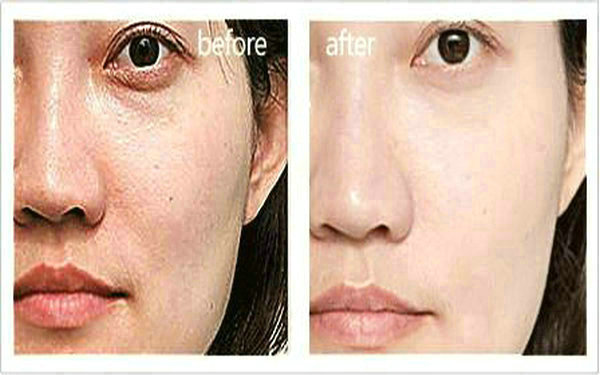 膨體和內助骨的區別