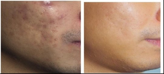 痘印痘坑如何修復了