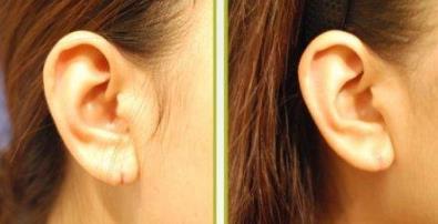 耳朵整形一般幾歲