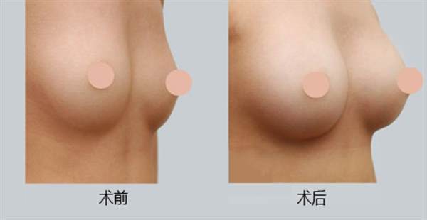 乳房拉皮案例手術后照片效果
