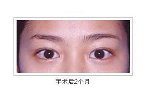  埋線法重瞼術(shù)的手術(shù)過程
