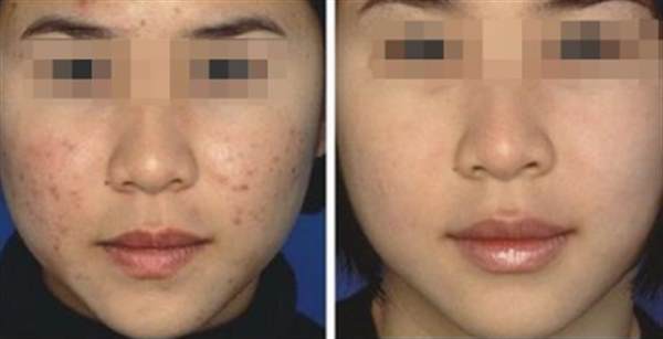 如何<a href=http://www.f3bb6.cn/listinfo-781-0.html target=_blank class=infotextkey>祛痘印</a>能打造完美肌膚