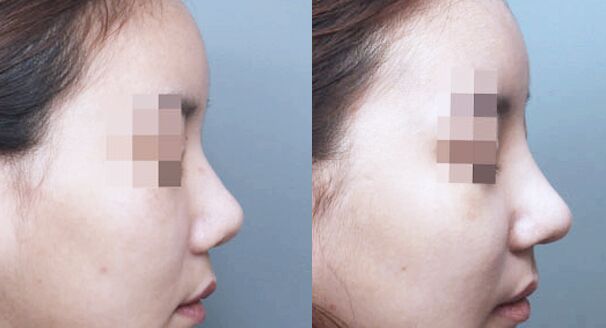 硅膠<a href=http://www.f3bb6.cn/listinfo-737-0.html target=_blank class=infotextkey>隆鼻</a>效果可以長期維持嗎