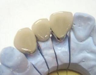 鈦合金<a href=http://www.f3bb6.cn/listinfo-829-0.html target=_blank class=infotextkey>烤瓷牙</a>禁忌人群