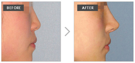 硅膠假體取出后遺癥有哪些