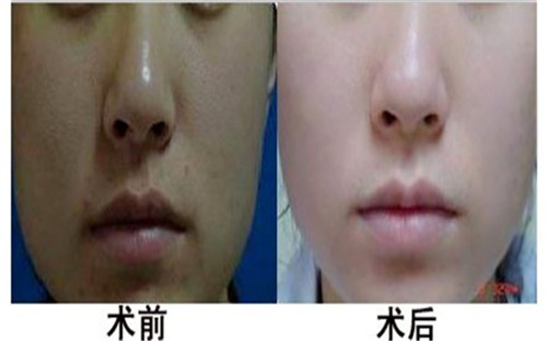 全臉點陣激光多少錢