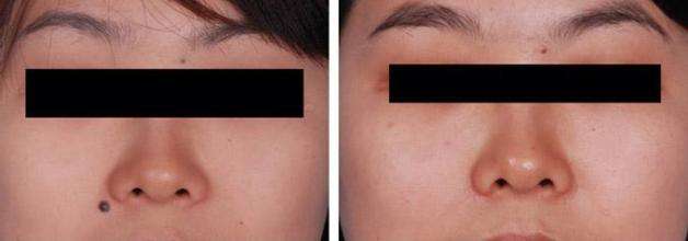 二氧化碳激光<a href=http://www.f3bb6.cn/listinfo-767-0.html target=_blank class=infotextkey>祛痣</a>疼嗎