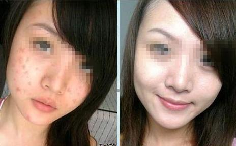 <a href=http://www.f3bb6.cn/listinfo-781-0.html target=_blank class=infotextkey>祛痘印</a>的方法有哪些