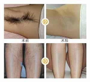 冰點<a href=http://www.f3bb6.cn/listinfo-670-0.html target=_blank class=infotextkey>脫毛</a>的危害