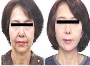 臉部皮膚松馳怎么辦