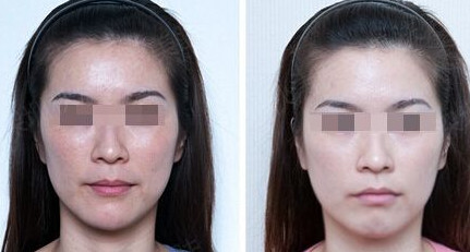 光子<a href=http://www.f3bb6.cn/listinfo-770-0.html target=_blank class=infotextkey>嫩膚</a>后可以洗臉嗎