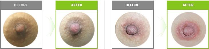 造成乳暈變黑的原因有哪些