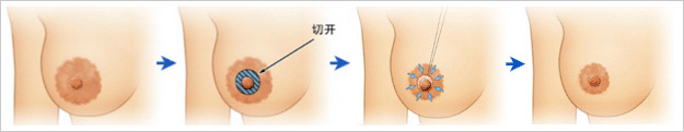 乳頭乳暈再造手術(shù)的適應(yīng)癥