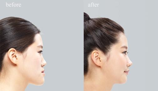 下巴<a href=http://www.f3bb6.cn/listinfo-634-0.html target=_blank class=infotextkey>磨骨整形</a>多少錢