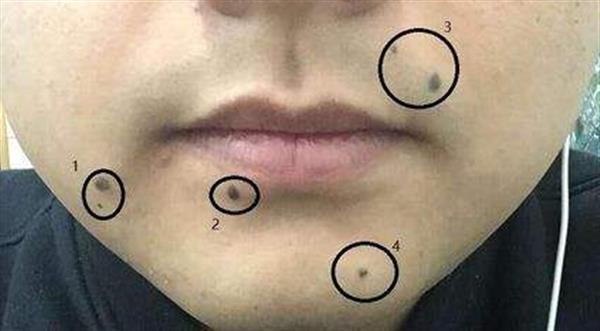 深州做激光去痣會(huì)留疤嗎