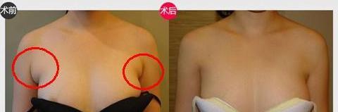 副乳切除手術怎么樣