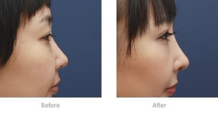 如何判斷假體是否下滑